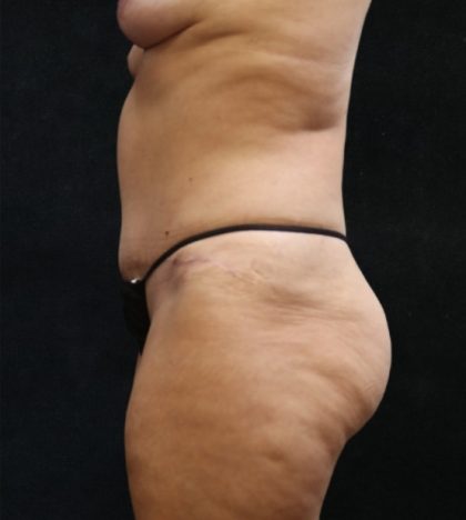 Tummy Tuck Before & After Patient #11535