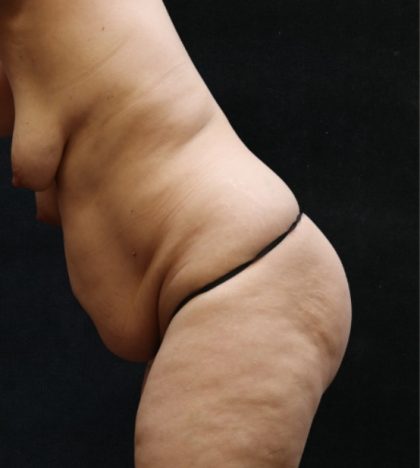Tummy Tuck Before & After Patient #11535