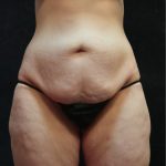Tummy Tuck Before & After Patient #11536