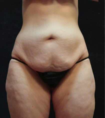 Tummy Tuck Before & After Patient #11536