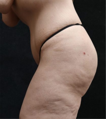 Tummy Tuck Before & After Patient #11536