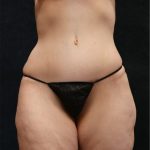 Tummy Tuck Before & After Patient #11536