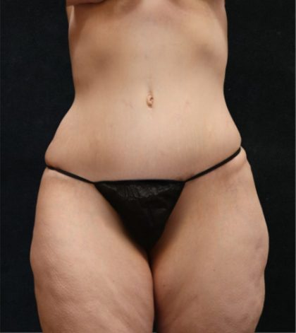 Tummy Tuck Before & After Patient #11536