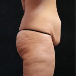 Tummy Tuck Before & After Patient #11536