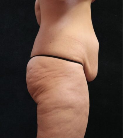 Tummy Tuck Before & After Patient #11536