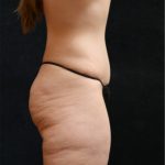 Tummy Tuck Before & After Patient #11536