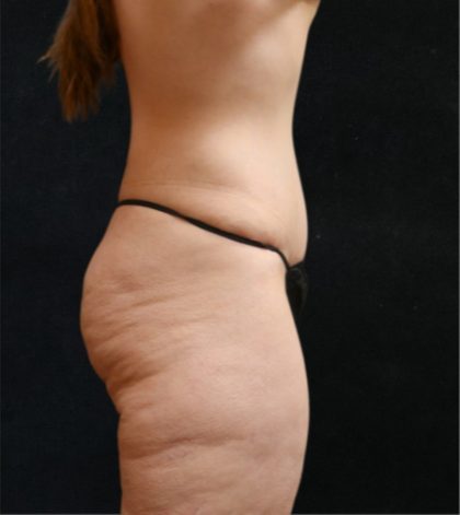 Tummy Tuck Before & After Patient #11536