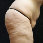 Tummy Tuck Before & After Patient #11536