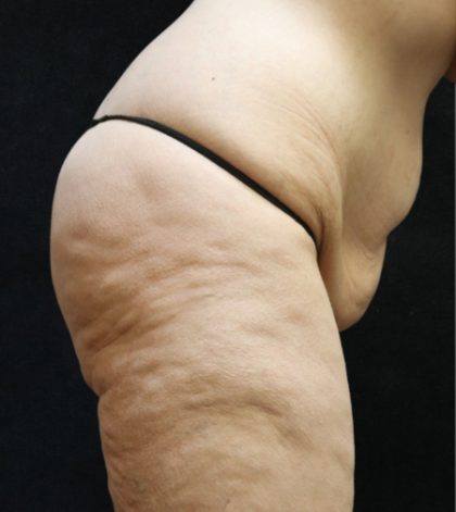Tummy Tuck Before & After Patient #11536