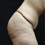 Tummy Tuck Before & After Patient #11536
