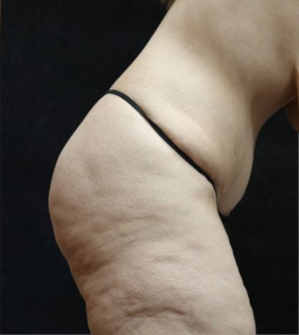 Tummy Tuck Before & After Patient #11536