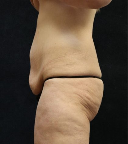 Tummy Tuck Before & After Patient #11536
