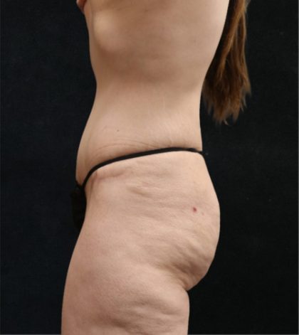 Tummy Tuck Before & After Patient #11536