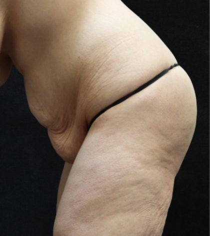 Tummy Tuck Before & After Patient #11536