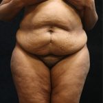 Tummy Tuck Before & After Patient #11537