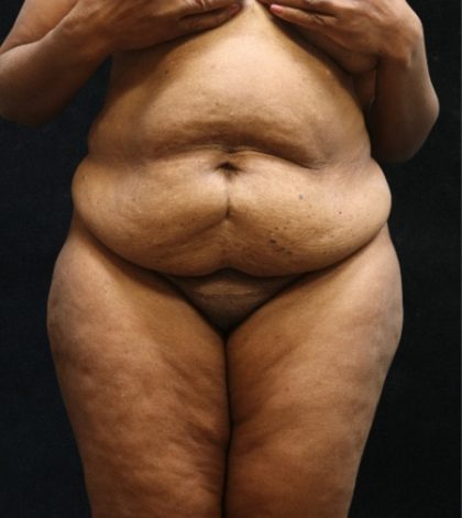 Tummy Tuck Before & After Patient #11537