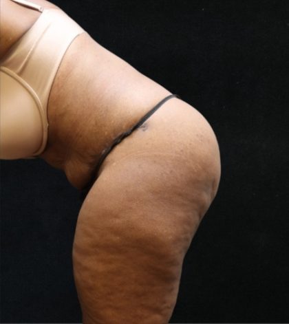 Tummy Tuck Before & After Patient #11537