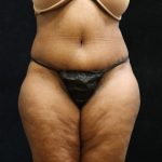 Tummy Tuck Before & After Patient #11537