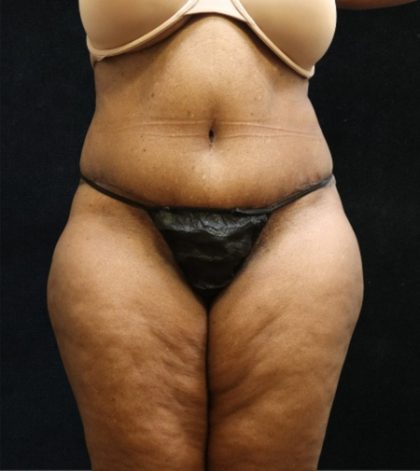 Tummy Tuck Before & After Patient #11537