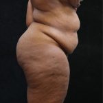 Tummy Tuck Before & After Patient #11537