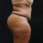 Tummy Tuck Before & After Patient #11537