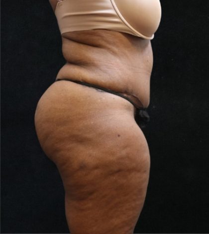 Tummy Tuck Before & After Patient #11537