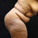 Tummy Tuck Before & After Patient #11537