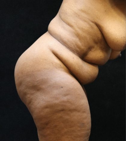 Tummy Tuck Before & After Patient #11537