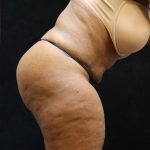 Tummy Tuck Before & After Patient #11537