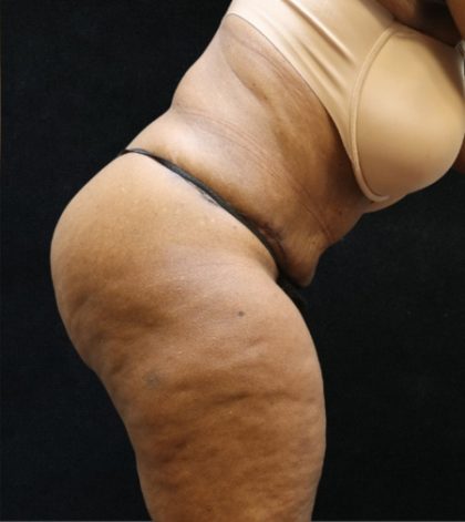 Tummy Tuck Before & After Patient #11537
