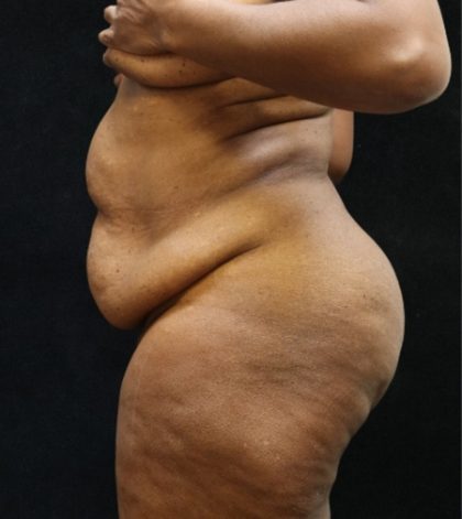 Tummy Tuck Before & After Patient #11537