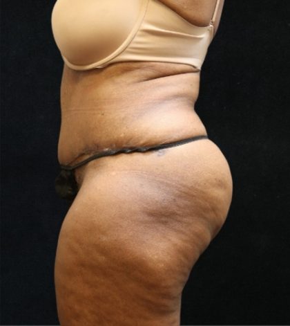 Tummy Tuck Before & After Patient #11537