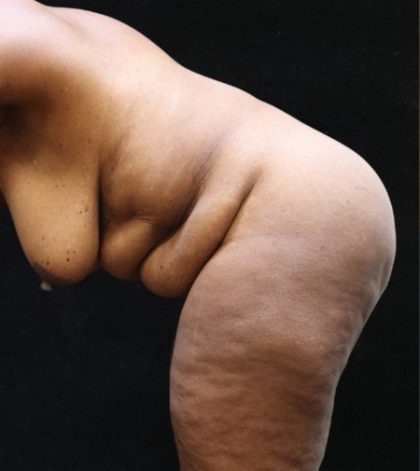 Tummy Tuck Before & After Patient #11537