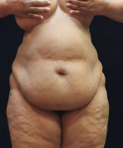 Tummy Tuck Before & After Patient #11538