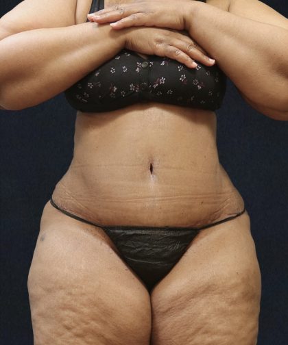 Tummy Tuck Before & After Patient #11538