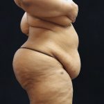 Tummy Tuck Before & After Patient #11538