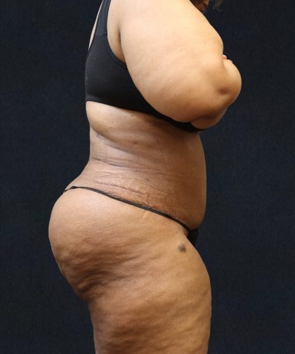 Tummy Tuck Before & After Patient #11538