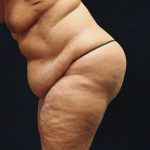 Tummy Tuck Before & After Patient #11538