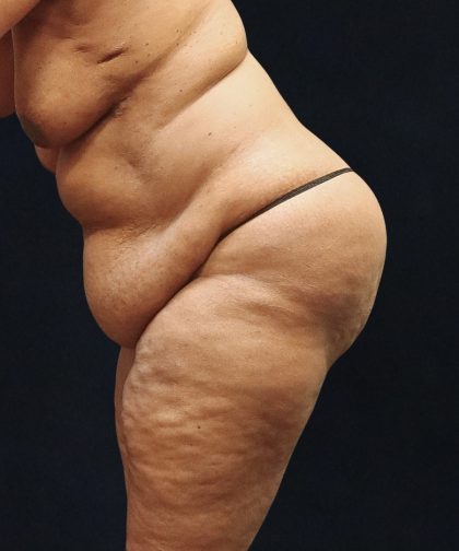 Tummy Tuck Before & After Patient #11538