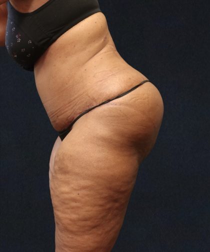 Tummy Tuck Before & After Patient #11538