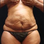 Tummy Tuck Before & After Patient #11539