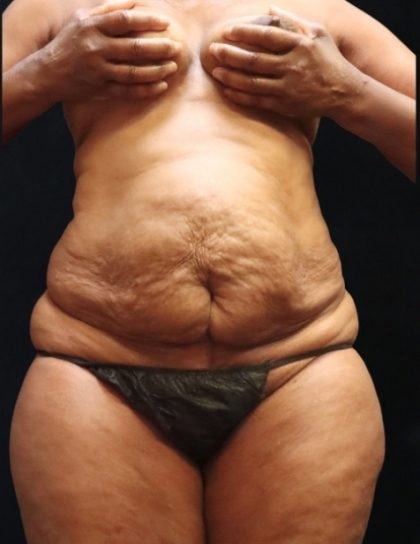 Tummy Tuck Before & After Patient #11539