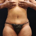 Tummy Tuck Before & After Patient #11539