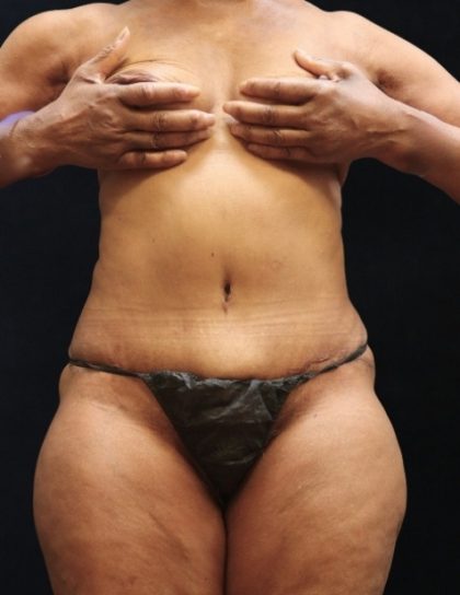Tummy Tuck Before & After Patient #11539