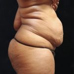 Tummy Tuck Before & After Patient #11539