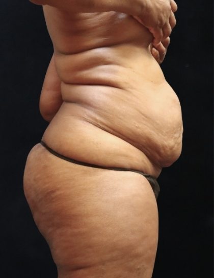 Tummy Tuck Before & After Patient #11539
