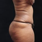 Tummy Tuck Before & After Patient #11539