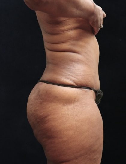 Tummy Tuck Before & After Patient #11539
