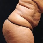 Tummy Tuck Before & After Patient #11539