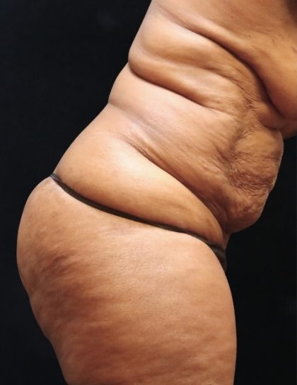 Tummy Tuck Before & After Patient #11539
